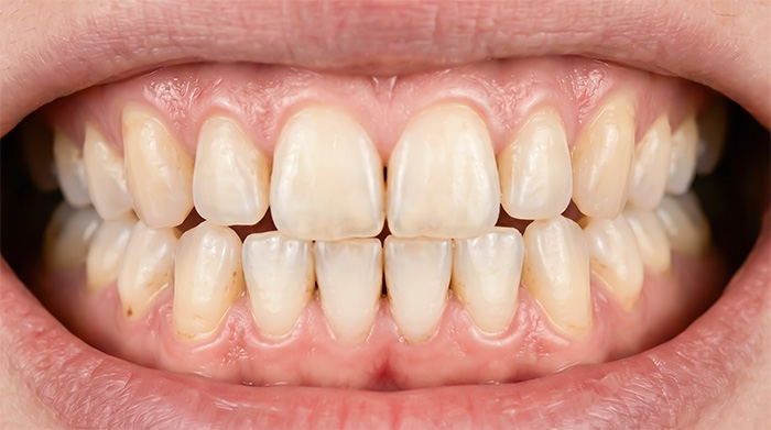 ホワイトニング前