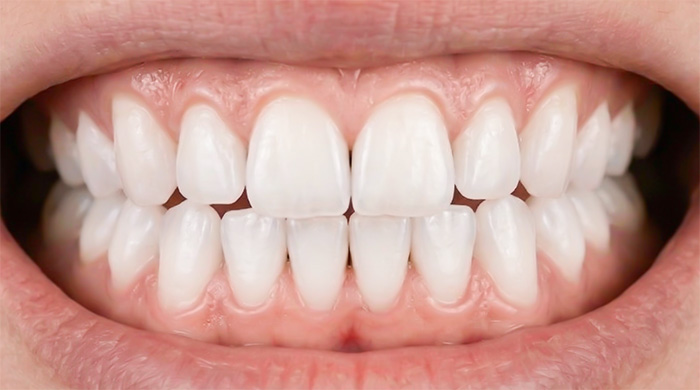 ホワイトニング後